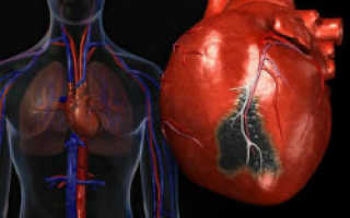 Кардиосклероз сердца