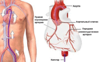 Последствия коронарографии сосудов сердца методы исследования и возможные осложнения
