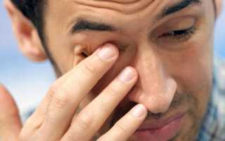 Причины и эффективные способы лечения красных глаз после сна