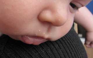 Что делать, если на лице у новорожденного появились жировики