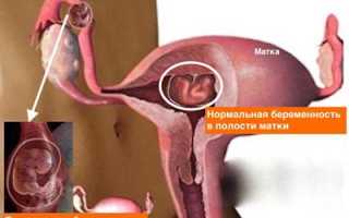 Операция при внематочной беременности