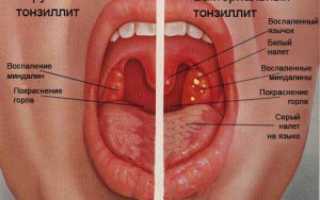 Лечение тонзиллита