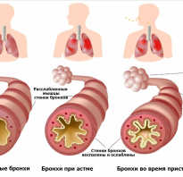 Бронхиальная астма — признаки, симптомы, диагностика
