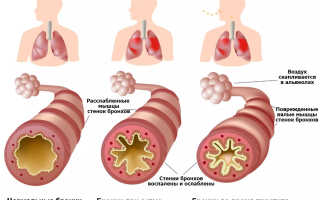 Бронхиальная астма — признаки, симптомы, диагностика