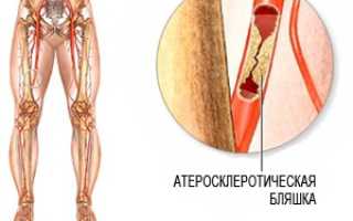 Облитерирующий атеросклероз артерий нижних конечностей (ОАСНК)