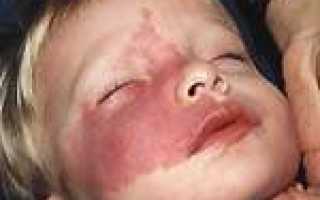 Возможности лечения сосудистых патологий кожи лазером