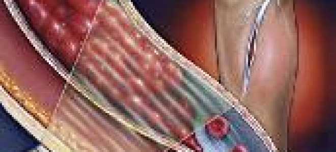 Тромботические осложнения в онкологии: профилактика и лечение