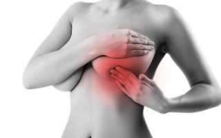 Фибрознокистозная мастопатия лечение симптомы причины профилактика