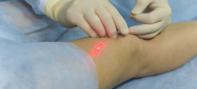 Лечение варикозной болезни