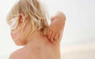 Аллергические дерматозы у детей