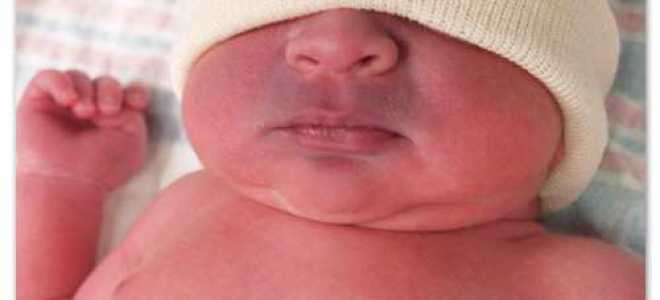 Синий носогубный треугольник у грудничка: почему