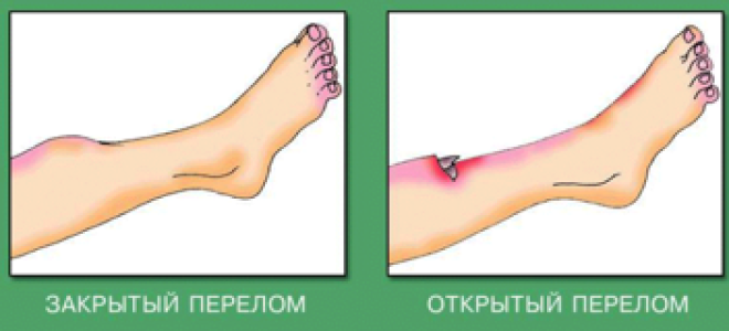 Первая помощь при переломах