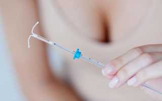 Спираль Мирена действие контрацептива особенности применения эффективность