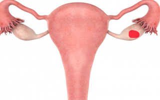 Рак яичников у женщин