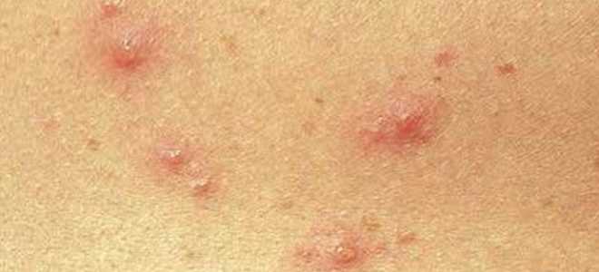 Ветрянка у детей и взрослых: как не заболеть и как лечиться