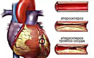 Атеросклеротический кардиосклероз: причины заболевания, основные симптомы, лечение и профилактика