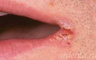 Заеды в уголках рта причины лечение трещин на губах