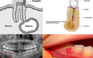 Киста зуба и способы ее лечения
