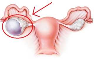 Характер выделений при кисте яичника изменения в менструациях
